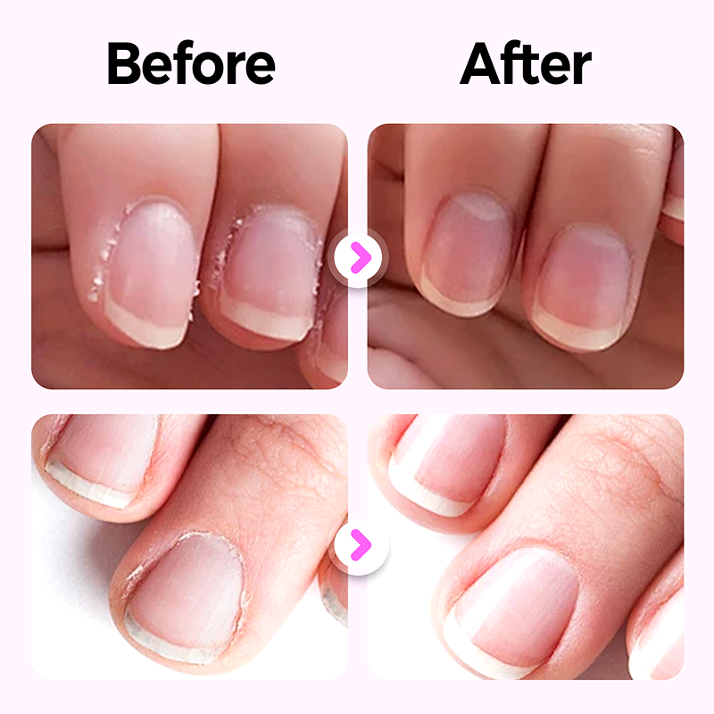 🔥Solange der Vorrat reicht 40 % Rabatt!🎉2025 Neuer und verbesserter 3-in-1-Nagelpflegestift.